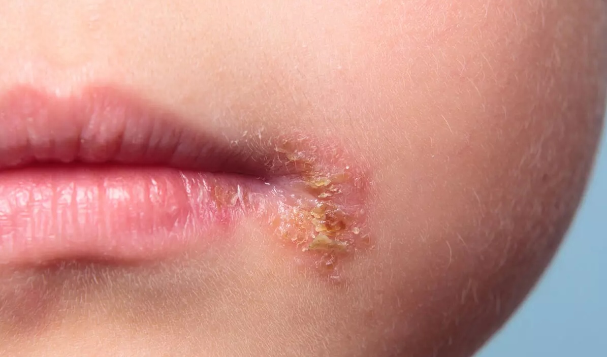 Impetigo Treatment