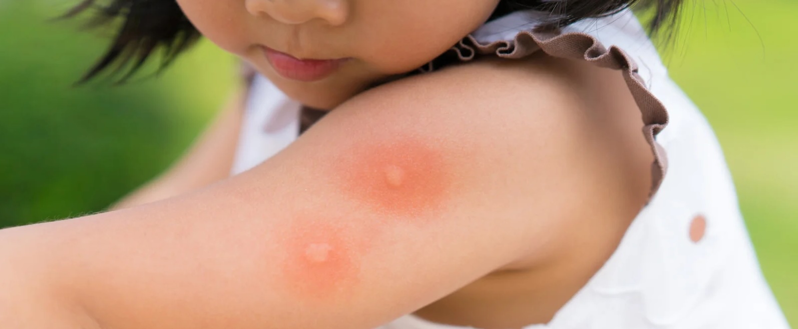 Infected Bites & Stings